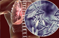 Туберкулёз. Знать о профилактике - важно. Заразиться может каждый. 