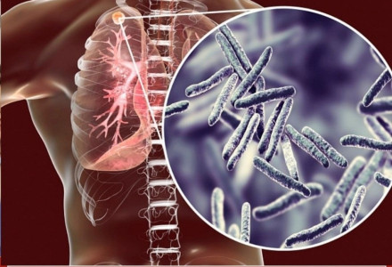 Туберкулёз. Знать о профилактике - важно. Заразиться может каждый. 